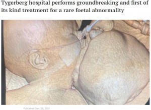 頭部と同じサイズの腫瘍を持って生まれてきたアイボリーちゃん（画像は『IOL News　2021年12月29日付「Tygerberg hospital performs groundbreaking and first of its kind treatment for a rare foetal abnormality」』のスクリーンショット）