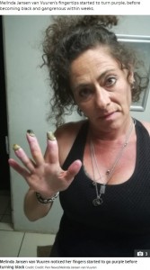 バージャー病を発症したメリンダさん（画像は『The Sun　2022年3月16日付「MY HORROR My fingers have turned black and could FALL OFF after years of smoking」（Credit: Pen News/Melinda Jansen van Vuuren）』のスクリーンショット）