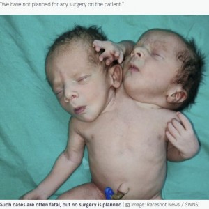 手術は予定していないという（画像は『The Mirror　2022年3月30日付「Baby born with two heads, three hands and two hearts after mum told to expect twins」（Image: Rareshot News / SWNS）』のスクリーンショット）