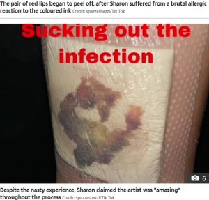 感染症を起こしガーゼを当てた患部（画像は『The Sun　2022年4月25日付「TATT’S SO GROSS I got a tattoo of lips on my leg…turns out I was allergic to the ink, the infection was so bad the thing peeled off」（Credit: spazzashazzi/Tik Tok）』のスクリーンショット）