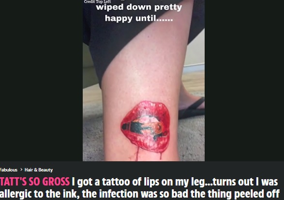 最初は鮮やかな赤い唇だったタトゥー（画像は『The Sun　2022年4月25日付「TATT’S SO GROSS I got a tattoo of lips on my leg…turns out I was allergic to the ink, the infection was so bad the thing peeled off」（Credit: spazzashazzi/Tik Tok）』のスクリーンショット）