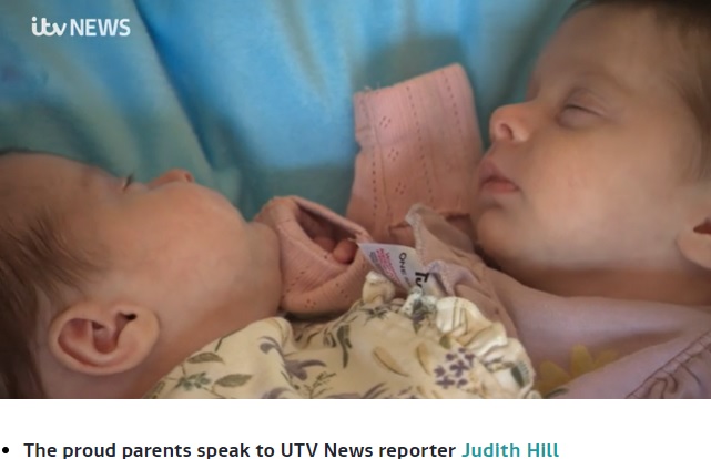 ハグが大好きだという2人（画像は『ITV News　2022年4月21日付「Northern Ireland couple welcome six-week-old ‘miracle’ conjoined twins」』のスクリーンショット）