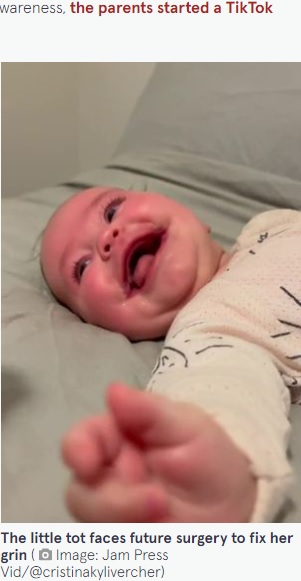 両側巨口症の女の子（画像は『The Mirror　2022年5月25日付「Baby born with permanent smile due to rare condition affecting just 14 people worldwide」（Image: Jam Press Vid/＠cristinakylivercher）』のスクリーンショット）