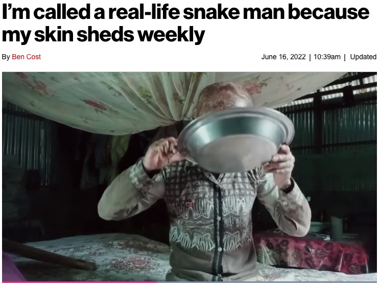 皮膚がヘビの鱗のようになってしまった男性（画像は『New York Post　2022年6月16日付「I’m called a real-life snake man because my skin sheds weekly」（Jam Press Vid/Rare Shot News）』のスクリーンショット）
