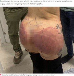 手術後の赤くなった臀部（画像は『The Daily Star　2022年6月7日付「Mum says Brazilian butt lift was ‘worst mistake of my life’ after it almost kills her」（Image: Kennedy News and Media）』のスクリーンショット）