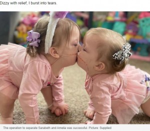 分離されキスをするサラベスちゃんとアメリアちゃん（画像は『news.com.au　2022年5月31日付「‘Your little sisters are stuck together’: Conjoined twins’ risky separation surgery」（Picture: Supplied）』のスクリーンショット）