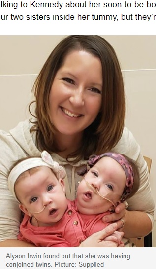 アリソンさんと分離される前の双子（画像は『news.com.au　2022年5月31日付「‘Your little sisters are stuck together’: Conjoined twins’ risky separation surgery」（Picture: Supplied）』のスクリーンショット）
