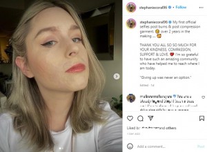 マスクを取った後初めての投稿（画像は『Stephanie Coral Browitt　2022年6月6日付Instagram「My first official selfies post burns」』のスクリーンショット）