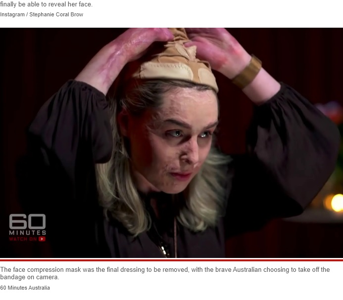 マスクを外すステファニーさん（画像は『New York Post　2022年6月6日付「Volcano burn survivor removes face mask for first time: ‘A real fighter’」（60 Minutes Australia）』のスクリーンショット）