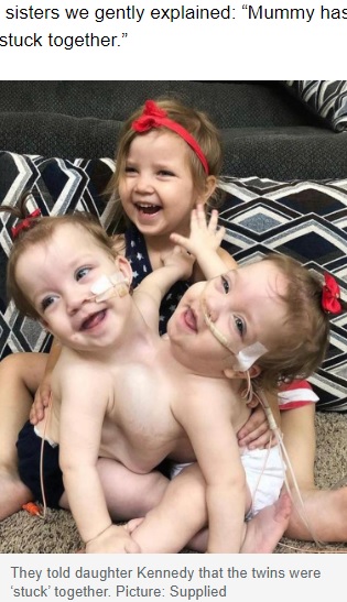 姉のケネディーちゃんと（画像は『news.com.au　2022年5月31日付「‘Your little sisters are stuck together’: Conjoined twins’ risky separation surgery」（Picture: Supplied）』のスクリーンショット）