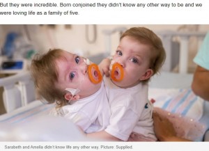 分離手術前の2人（画像は『news.com.au　2022年5月31日付「‘Your little sisters are stuck together’: Conjoined twins’ risky separation surgery」（Picture: Supplied）』のスクリーンショット）