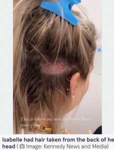 ポーランドで植毛の施術を受けた女性（画像は『The Mirror　2022年7月6日付「Woman gets eyebrow transplant with hair from head - but now has to keep cutting them」（Image: Kennedy News and Media）』のスクリーンショット）
