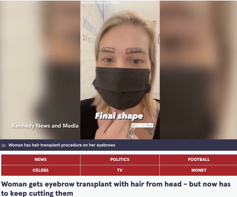 眉毛へ植毛する女性（画像は『The Mirror　2022年7月6日付「Woman gets eyebrow transplant with hair from head - but now has to keep cutting them」（Image: Kennedy News and Media）』のスクリーンショット）