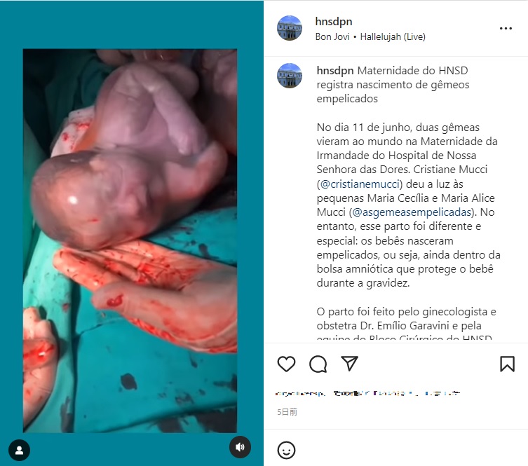 羊膜の中の表情もはっきりと（画像は『Hospital N. Senhora das Dores　2022年7月14日付Instagram「Maternidade do HNSD registra nascimento de gêmeos empelicados」』のスクリーンショット）