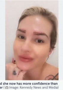施術直後の女性（画像は『The Mirror　2022年7月6日付「Woman gets eyebrow transplant with hair from head - but now has to keep cutting them」（Image: Kennedy News and Media）』のスクリーンショット）