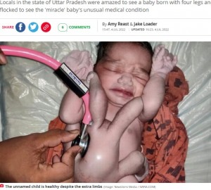手が4本、脚が4本で誕生した女児（画像は『The Daily Star　2022年7月4日付「Baby born with four arms and four legs hailed as ‘miracle of nature’」（Image: Newslions Media / SWNS.COM）』のスクリーンショット）