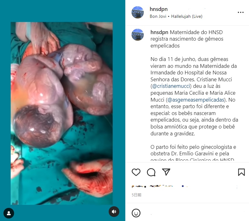 卵膜と羊水に包まれた“被膜児”の双子姉妹（画像は『Hospital N. Senhora das Dores　2022年7月14日付Instagram「Maternidade do HNSD registra nascimento de gêmeos empelicados」』のスクリーンショット）