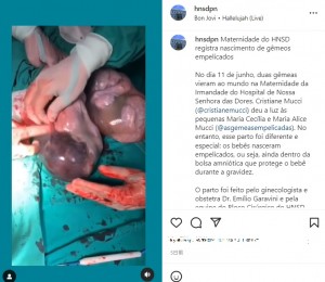 羊膜をつまむ医師（画像は『Hospital N. Senhora das Dores　2022年7月14日付Instagram「Maternidade do HNSD registra nascimento de gêmeos empelicados」』のスクリーンショット）