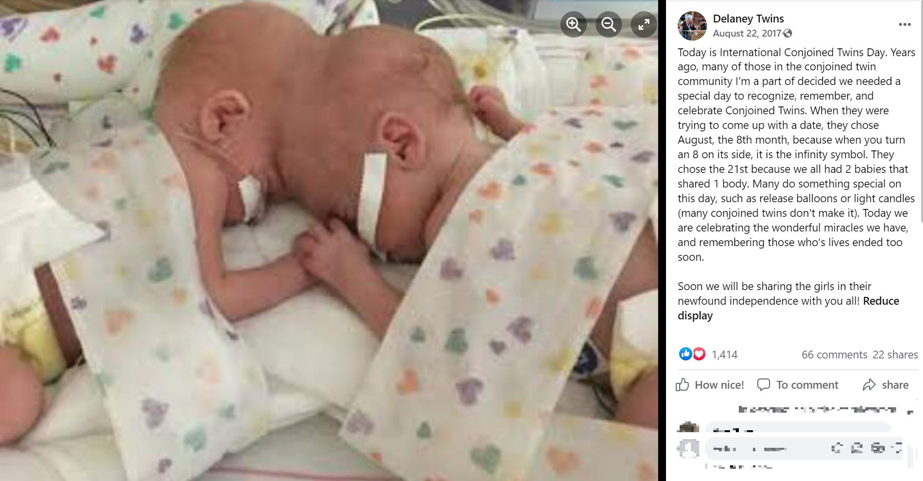 頭部が結合して誕生した姉妹（画像は『Delaney Twins　2017年8月22日付Facebook「Today is International Conjoined Twins Day.」』のスクリーンショット）