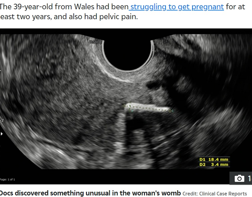 20年前に中絶した胎児の骨片（画像は『The Sun　2022年7月4日付「MAMMA MIA Doctors discover staggering reason woman couldn’t get pregnant after abortion 20 years ago」（Credit: Clinical Case Reports）』のスクリーンショット）