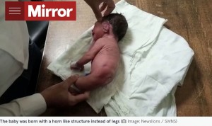 まるで角？（画像は『The Mirror　2022年8月29日付「Doctors stunned after a baby is born with a horn-like structure instead of legs」（Image: Newslions / SWNS）』のスクリーンショット）