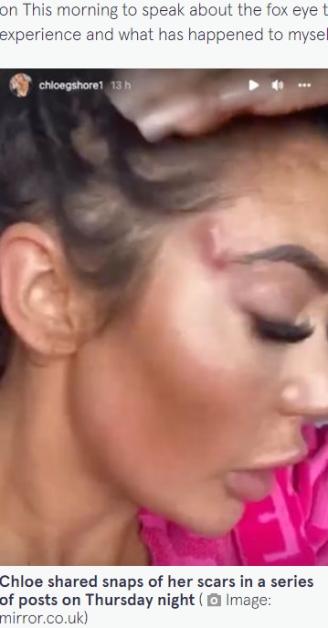 施術後、こめかみにカプセル剤？（画像は『The Mirror　2022年8月5日付「Chloe Ferry shares butchered face after fox eye surgery left gaping holes in her skin」（Image: mirror.co.uk）』のスクリーンショット）