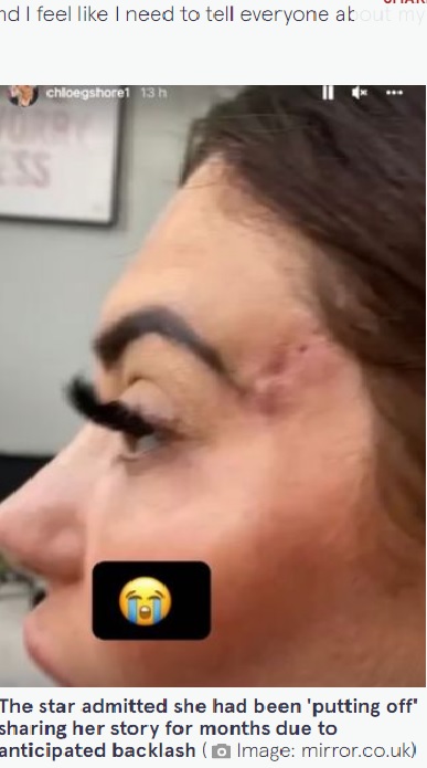 今でもこめかみの傷は消えず（画像は『The Mirror　2022年8月5日付「Chloe Ferry shares butchered face after fox eye surgery left gaping holes in her skin」（Image: mirror.co.uk）』のスクリーンショット）