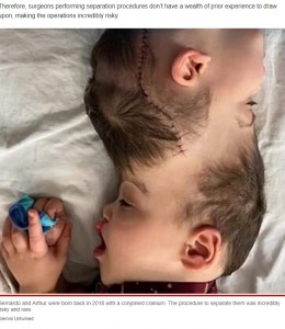 分離される前にも手術を受けた2人（画像は『New York Post　2022年8月1日付「Conjoined twins born with fused brains separated after 27-hour surgery」（Gemini Untwined）』のスクリーンショット）