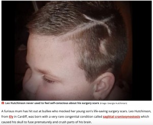 頭部に大きな傷痕があるレオ君（画像は『WalesOnline　2022年9月12日付「Angry mum hits out at bullies who mocked her young son’s life-saving surgery scars」（Image: Georgia Hutchinson）』のスクリーンショット）