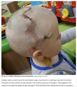 幼少期に受けた2回目の手術痕（画像は『WalesOnline　2022年9月12日付「Angry mum hits out at bullies who mocked her young son’s life-saving surgery scars」（Image: Georgia Hutchinson）』のスクリーンショット）