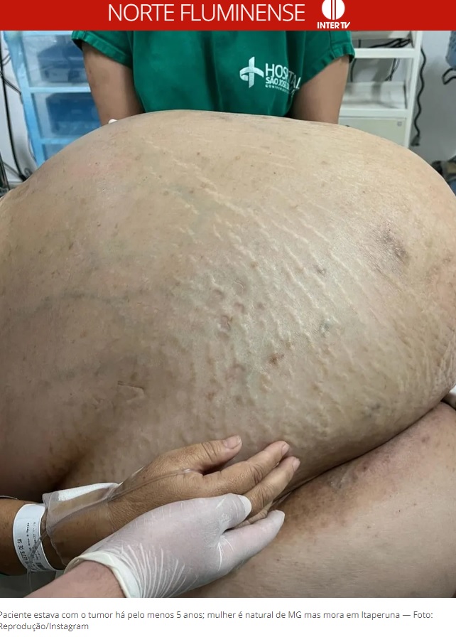 医師も驚いたという女性の腹部（画像は『G1　2022年9月1日付「Tumor com cerca de 46 kg é retirado de mulher em cirurgia de emergência em Itaperuna, no RJ」（Foto: Reprodução/Instagram）』のスクリーンショット）