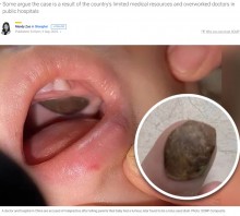 【海外発！Breaking News】「上あごに腫瘍」と診断された男児、別の病院で“蓮の実の殻”と判明し両親憤慨（中国）