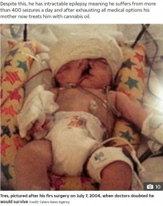 2004年7月7日に行われた最初の手術の後（画像は『The Sun　2017年6月6日付「THE BOY WITH TWO FACES ‘Miracle’ boy born with extremely rare condition that gave him ‘two faces’ defies odds to celebrate 13th birthday」（Credit: Caters News Agency）』のスクリーンショット）