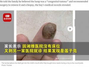 上あごに張り付いていた蓮の実の殻（画像は『South China Morning Post　2022年9月9日付「Chinese baby with lotus seed shell stuck in mouth misdiagnosed with tumour, embroiling public health system in scandal」（Photo: Toutiao）』のスクリーンショット）