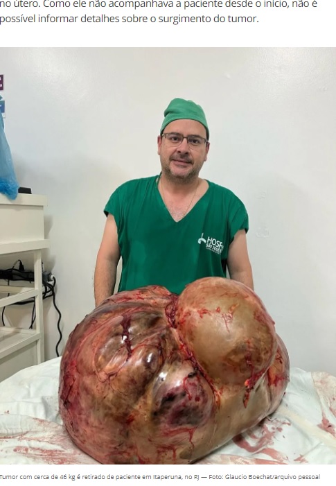 摘出された約46キロの腫瘍（画像は『G1　2022年9月1日付「Tumor com cerca de 46 kg é retirado de mulher em cirurgia de emergência em Itaperuna, no RJ」（Foto: Reprodução/Instagram）』のスクリーンショット）