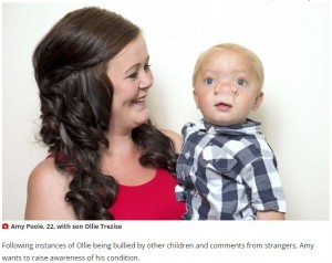 【海外発！Breaking News】“ピノキオ”のような鼻を生後9か月で手術した男児が8歳に　母親が写真を公開（英）