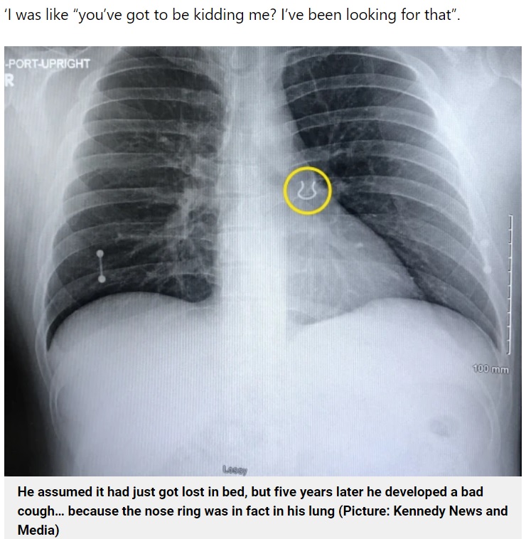 レントゲン写真には見覚えのある影が（画像は『Metro　2022年9月16日付「Man discovers nose ring he ‘lost in the night’ had been lodged in his lung for the last five years」（Picture: Kennedy News and Media）』のスクリーンショット）