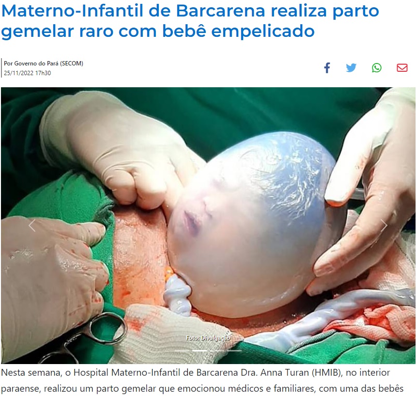 卵膜を通して確認できるジュリアちゃんの顔（画像は『Agência Pará de Notícias　2022年11月25日付「Materno-Infantil de Barcarena realiza parto gemelar raro com bebê empelicado」（Foto: Divulgação）』のスクリーンショット）