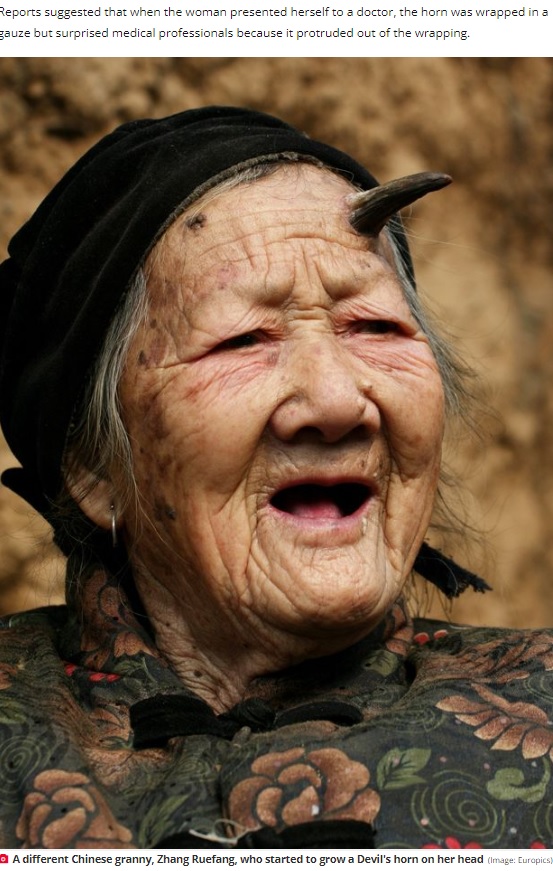 頭に皮角が生えていた中国人女性も（画像は『The Daily Star　2022年11月17日付「Grandmother, aged 91, has ultra-rare 7cm long ‘fairy’ horn growing on her arm」（Image: Europics）』のスクリーンショット）