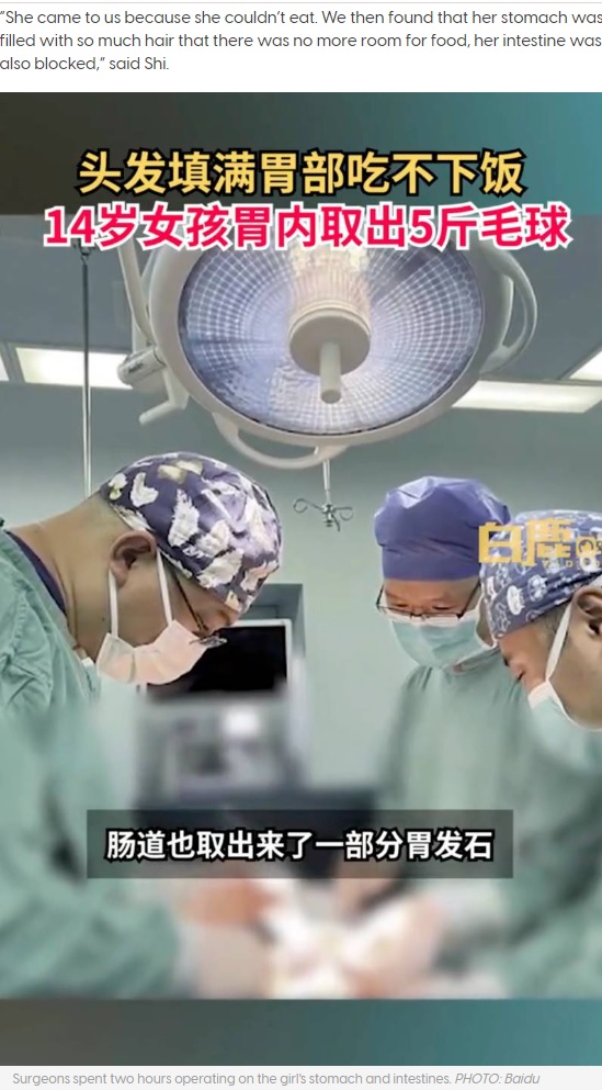 毛髪の摘出手術をする医師（画像は『AsiaOne　2022年11月26日付「‘Almost completely bald’: Troubled teen in China pulls out and eats 3kg of own hair」（PHOTO: Baidu）』のスクリーンショット）