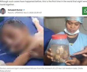 女児（左）から摘出された不完全な胎児（画像は『India Today　2022年11月3日付「8 undeveloped fetuses found inside stomach of newborn baby」（India Today photo）』のスクリーンショット）