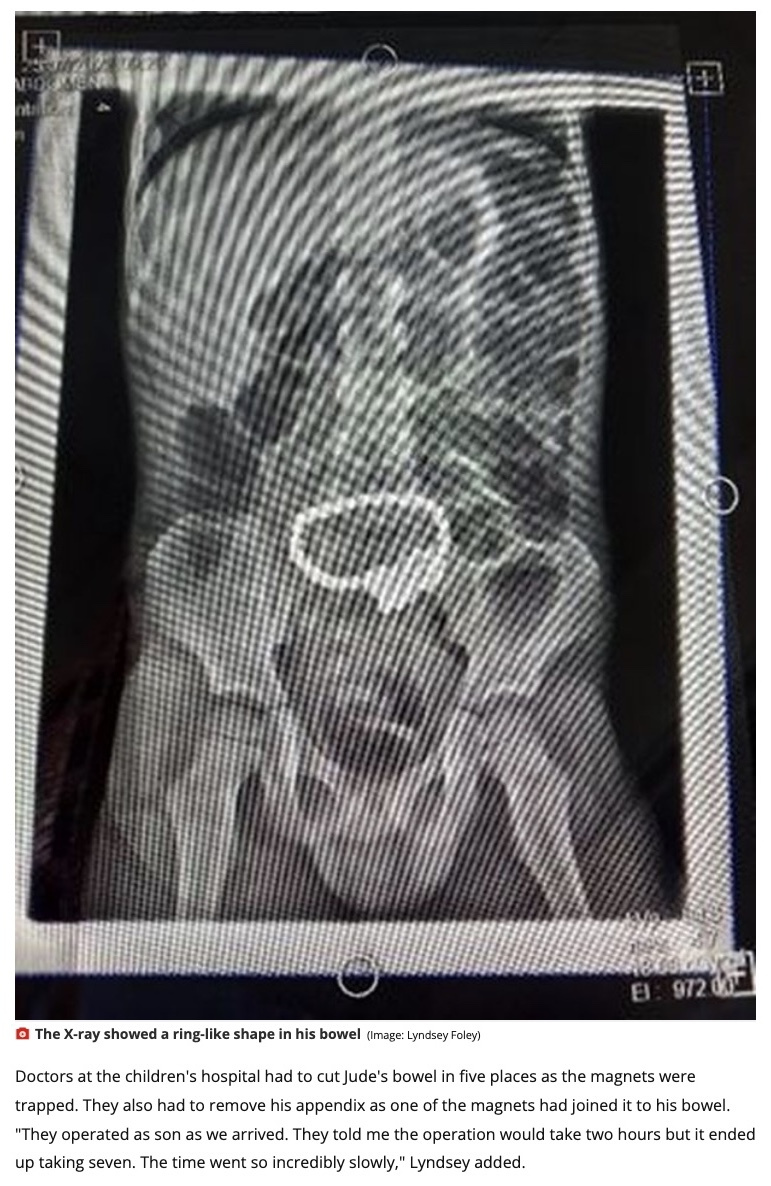 レントゲン写真でリング状に繋がったマグネットボールが明らかに（画像は『Wales Online　2022年12月20日付「Five-year-old suffering stomach pains for months rushed to emergency surgery after X-ray found 52 toy magnetic balls in his bowel」（Image: Richard Swingler）』のスクリーンショット）