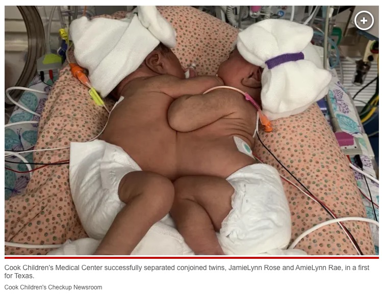 肝臓を共有する結合双生児（画像は『New York Post　2023年1月27日付「Infant conjoined twins successfully separated in ‘historic surgery’ at Texas hospital」（Cook Children’s Checkup Newsroom）』のスクリーンショット）