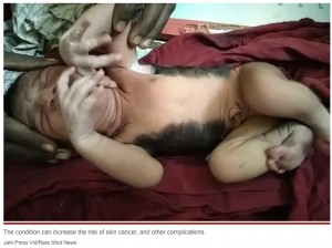 先天性巨大色素性母斑は皮膚がんやその他の合併症のリスクが高まるという（画像は『New York Post　2022年12月29日付「Baby with rare condition born with over half his body covered in hair」（Jam Press Vid/Rare Shot News）』のスクリーンショット）