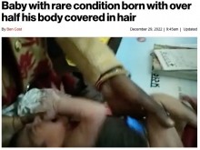 【海外発！Breaking News】体の半分以上が真っ黒な毛で覆われた赤ちゃんが生まれる（印）＜動画あり＞