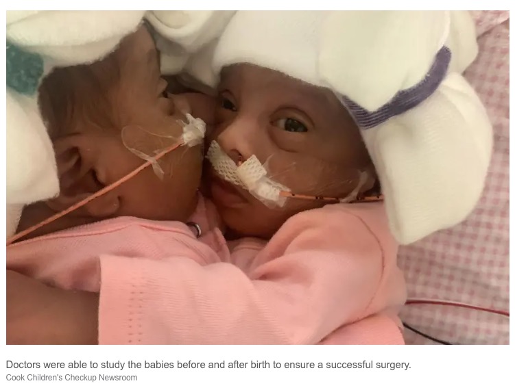手術に挑む双子姉妹（画像は『New York Post　2023年1月27日付「Infant conjoined twins successfully separated in ‘historic surgery’ at Texas hospital」（Cook Children’s Checkup Newsroom）』のスクリーンショット）