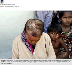 3年間で角が大きくなり苦痛だと訴えるミミヤさん（画像は『The New Indian　2022年12月29日付「Horns out of head: MP woman suffers from rare disease, doctors clueless」』のスクリーンショット）
