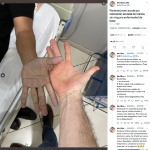 【海外発！Breaking News】「血栓症？」手が真っ青になり病院に駆け込むも、予想外の診断（パラグアイ）
