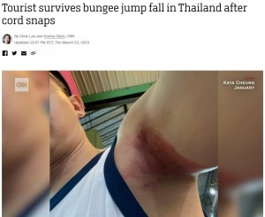 あまりの痛みでマイクさんは意識を失いかけたが、待機していたスタッフが泳いで救出に向かった。病院で検査や治療を受けたマイクさんの身体には、広範囲に赤黒く痛々しい痣が残っていた（画像は『CNN Travel　2023年3月23日付「Tourist survives bungee jump fall in Thailand after cord snaps」』のスクリーンショット）