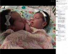 「中絶を」と言われた結合双生児の姉妹、分離せず元気な6歳に（米）＜動画あり＞